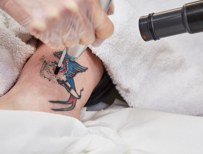 Tattoo Removal machine Close Up