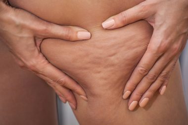 Girl holding and pushing the skin of the legs to show cellulite