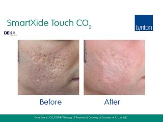 SmartXide Touch fractional Co2 Acne Scarring Before and After One Treatment Result on Face