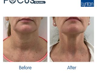 Skin Laxity Focus Dual Before and After