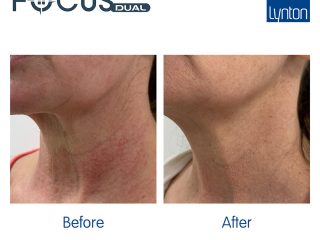 Skin Laxity Focus Dual Before and After