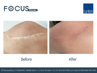 Focus-Dual-Before-and-After-3-RF-Microneedling-Treatments-Nikki-ButleFocus-Dual-Before-and-After-3-RF-Microneedling-Treatments-Nikki-Butler-Skin-Clinic-Webr-Skin-Clinic-Web