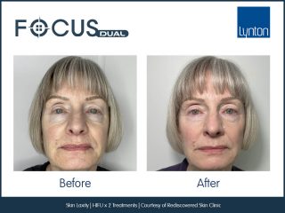 Focus Dual HIFU Face Treatment Results