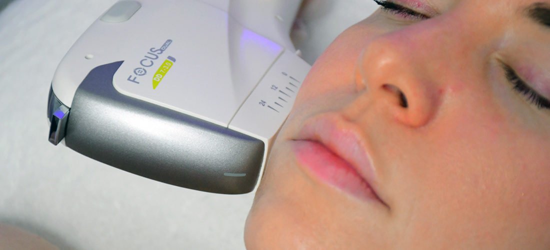 Lynton Focus Dual HIFU Handpiece on Woman Cheek