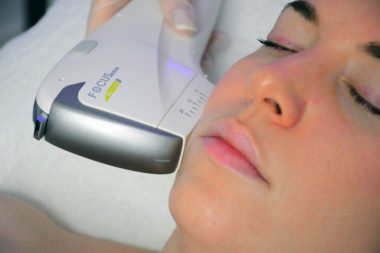 Lynton Focus Dual HIFU Handpiece on Woman Cheek