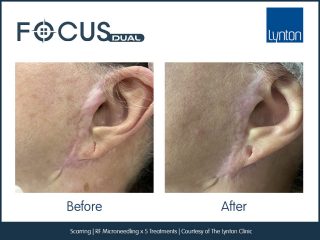 Focus Dual RF Microneedling Face Scar Treatment Results