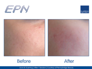 EPN Pen Before and After Wrinkle Treatment on a Woman's Face