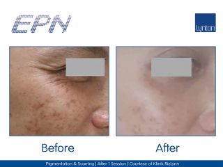EPN Pen professional microneedling pen Before and After Result on Woman Face