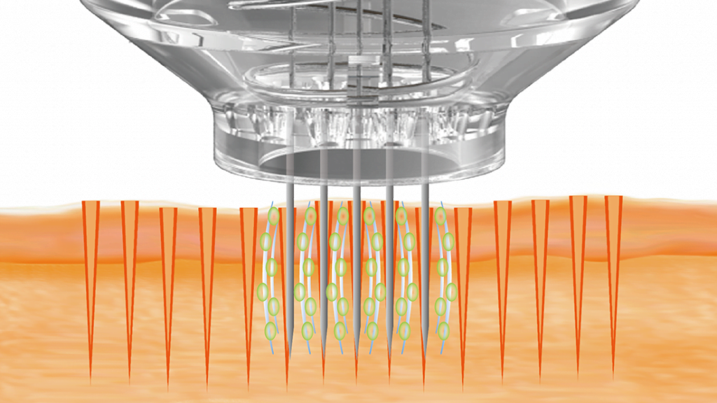 Mesotherapy VS Microneedling • Lynton