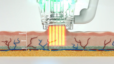 Focus Daul Insulated Microneedles inserting RF into skin