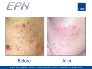 EPN Pen Acne and Scarring Before and After Results