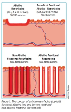 The concept of ablative resurfacing