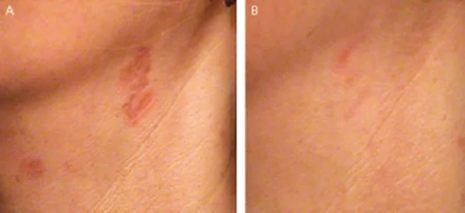 Prescars on the neck before and after PDL treatment