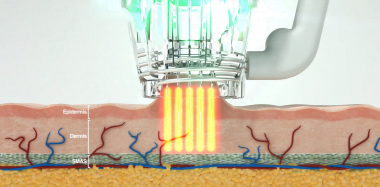 Focus Dual Radiofrequency Microneedling Technology in Action