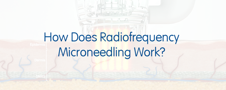 How Does Radiofrequency Microneedling Work?