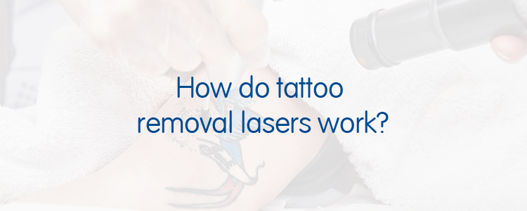 How do tattoo removal lasers work?