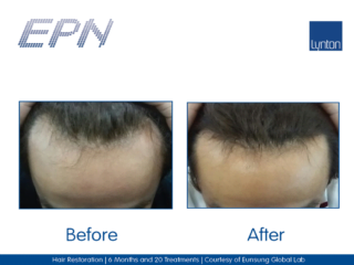 EPN Pen Hair Restoration After 20 Treatments