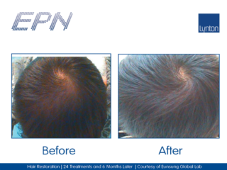 Micro needling and Hair Restoration After 24 Treatments