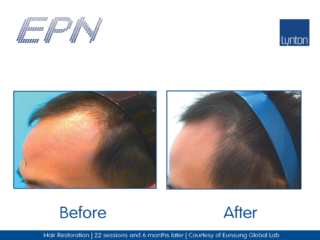 EPN Pen Hair Restoration After 22 Treatments
