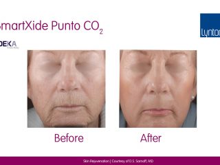 SmartXide Punto - Skin Rejuvenation