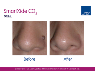 CO2 Laser Resurfacing before / after