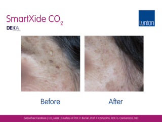 Skin Resurfacing CO2 Laser before and after