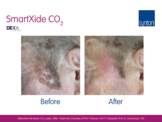 before and after Skin Resurfacing CO2 Laser