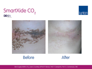 CO2 Laser Skin Resurfacing before and after