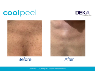 CO2 Laser Resurfacing before / after