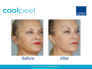 Coolpeel Before and After Results