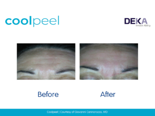 Coolpeel CO2 laser wrinkle treatment before and after images