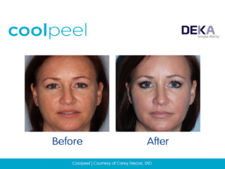 Coolpeel CO2 Laser skin resurfacing Before-after images