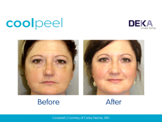 Coolpeel CO2 Laser Before and after images