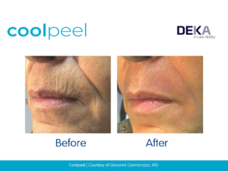 Coolpeel CO2 Laser skin resurfacing Before and after images