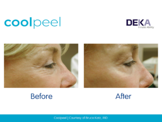 Coolpeel Before and after images