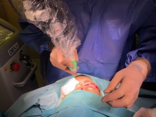Surgical Laser Blepharoplasty Treatment in Action