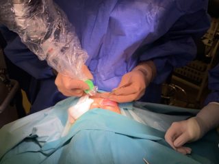 Surgical Laser Blepharoplasty Treatment in Action