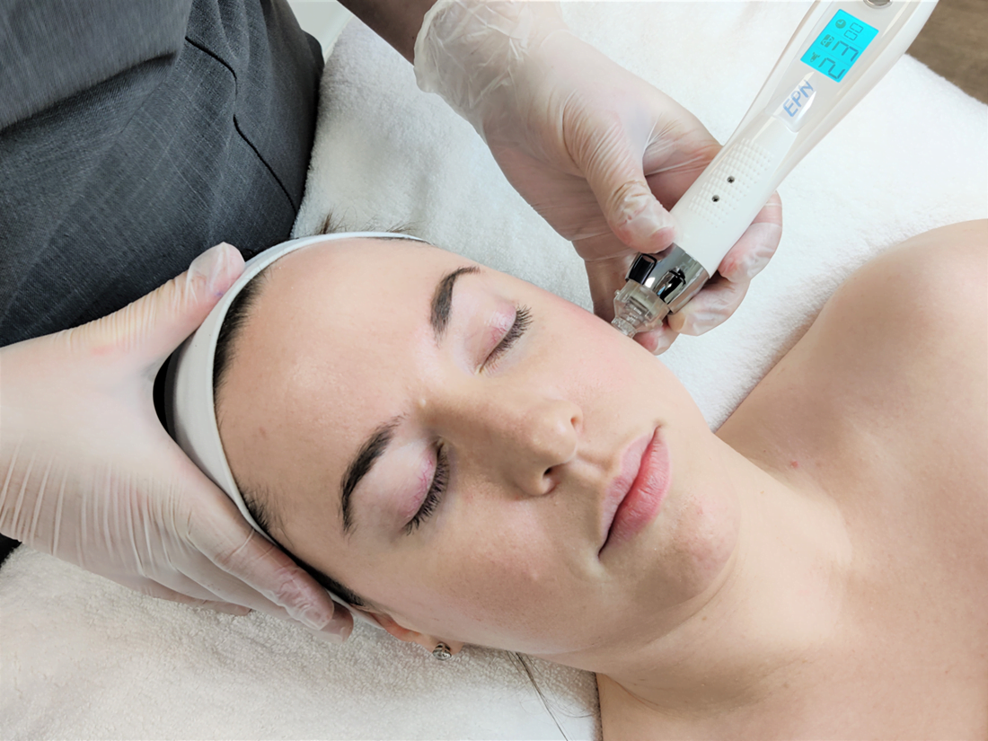 combining Microneedling with Chemical peels