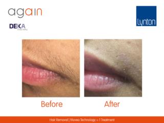 AGAIN by DEKA Hair Removal Before and After on Top lip