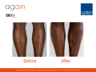 AGAIN by DEKA Hair Removal Before and After on Legs