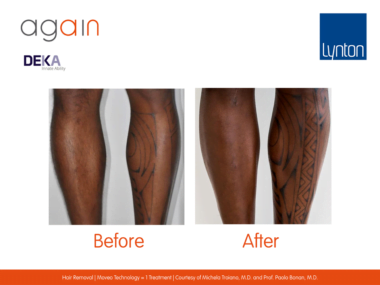 AGAIN by DEKA Hair Removal Before and After on Legs