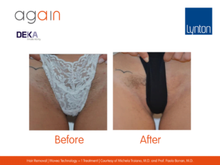 AGAIN by DEKA Hair Removal Before and After on Bikini Line