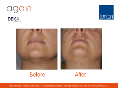 AGAIN by DEKA Hair Removal Before and After on Ladies Chin