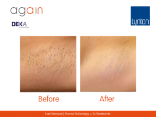 AGAIN by DEKA Hair Removal Before and After on Underarm