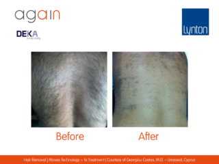 AGAIN by DEKA Hair Removal Before and After on Back