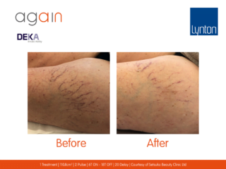 AGAIN DEKA Laser Thread Veins Before and After on Leg