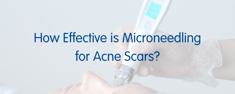 How effective is microneedling for acne scars?