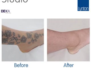 Tattoo Removal before and after