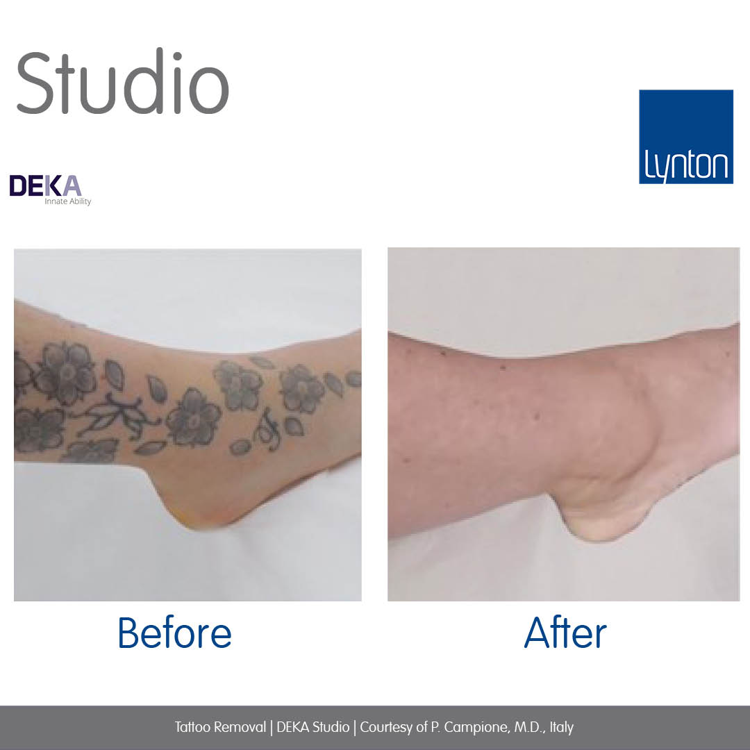 STUDIO - Powerful and Compact Tattoo Removal Laser by DEKA