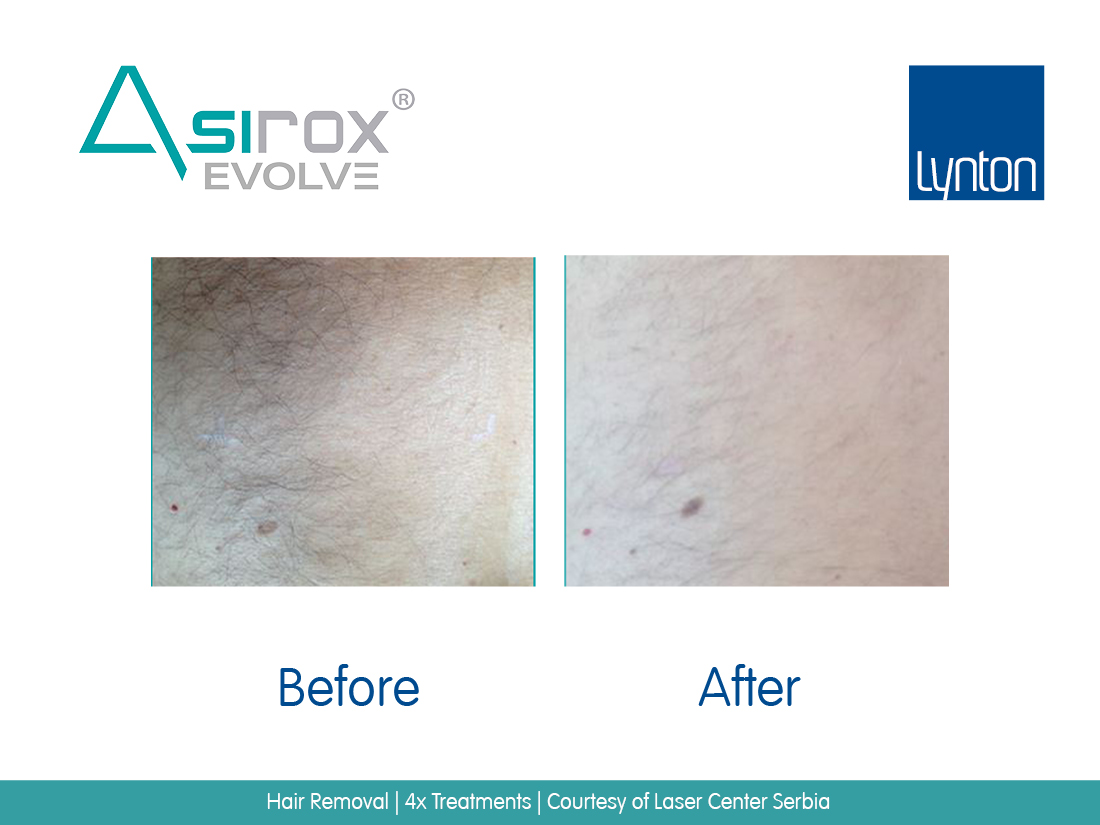 EVOLVE Diode Laser for Pain-Free Hair Removal on All Skin Types